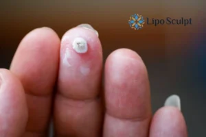 Cryopen Top 5 Treatable Conditions 4 Do you have a persistent wart of verruca that you cannot shit? Cryopen Gerrards Cross treatment will work call us NOW!