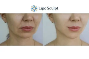 Explaining Total Skin Tightening Treatment And What It Can Do For You 2 Do you want to boost your self confidence? Give Morpheus8 Gerrards Cross a try today!