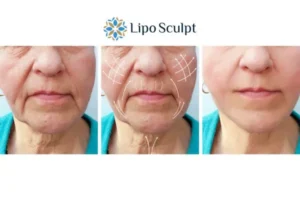 Explaining Total Skin Tightening Treatment And What It Can Do For You 3 Boost your confidence with Morpheus8 Gerrards Cross call our team today!