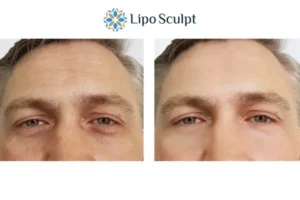 Explaining Total Skin Tightening Treatment And What It Can Do For You 6 Morpheus8 Gerrards Cross book in today to find out more!