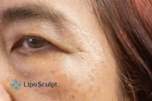 Cryopen: The Revolutionary Treatment for Age Spots Unveiled 2 Are age spots Gerrards Cross giving you low self esteem? Contact us today!