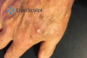 Best Actinic Keratoses Removal 2 Improve your wellbeing and health with Actinic Keratoses Gerrards Cross removal.treatment