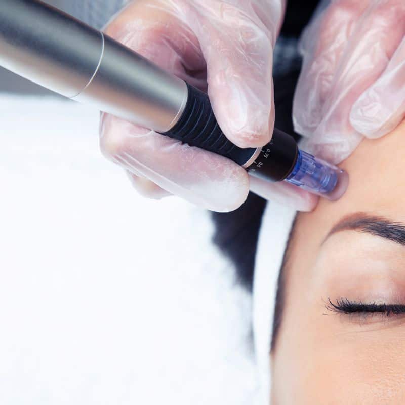 Morpheus8 treatment Gerrards Cross from Lipo Sculpt - Book in today!