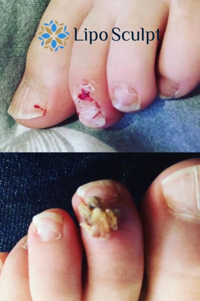 Wart removal customer results from Lipo Sculpt Gerrards Cross