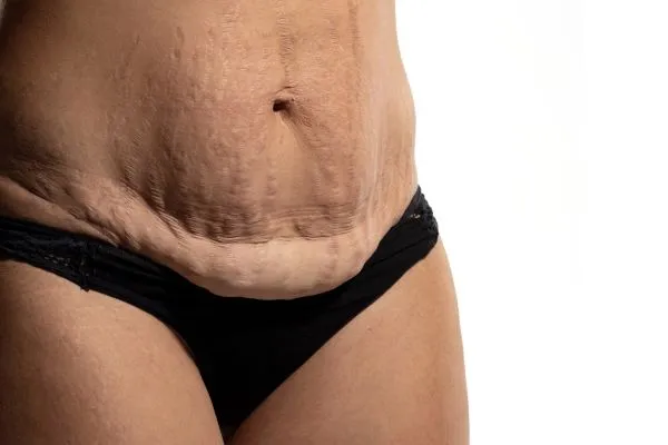 Lost the Weight but Not the Loose Skin? 1 image of womans stomach after weight loss showing loose skin Gerrards Cross